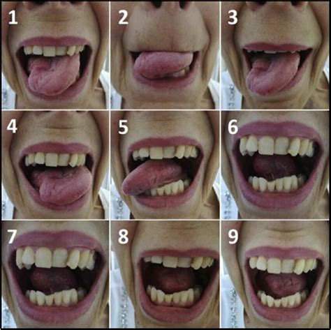 The nine movements of the tongue motility assessment in patient who... | Download Scientific Diagram