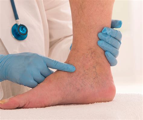 Spider-Veins-Prevented - Southernmost Foot & Ankle Specialists