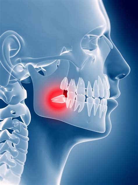 Wisdom Teeth Colorado Springs | Rocky Mountain Periodontal Specialists