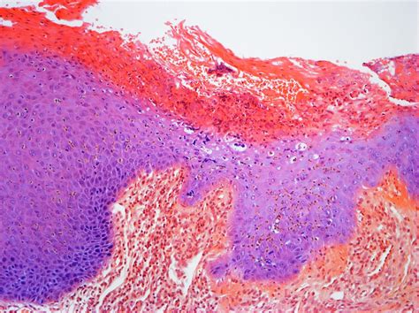 Oral Candidiasis Histology