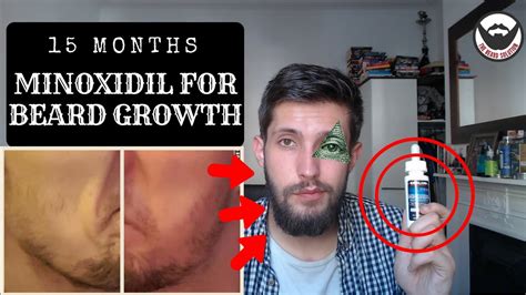 Minoxidil Beard Growth Results | 15 Months on Minoxidil for beard ...