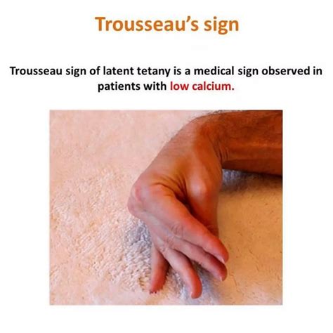 Trousseau's Sign Of Latent Tetany Explained, 57% OFF