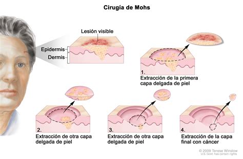 Tratamiento del cáncer de piel (PDQ®)–Versión para profesionales de salud - NCI