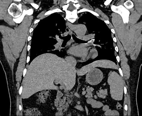 Beaver Tail Liver: A Hepatic Morphology Variant | Cureus