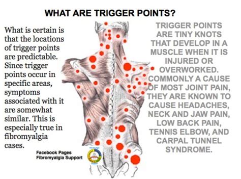 Fibromyalgia trigger points | Fibromyalgia, Chronic migraines ...