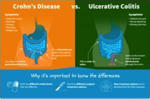 Crohn's Disease vs Ulcerative Colitis - Woburn Osteopaths