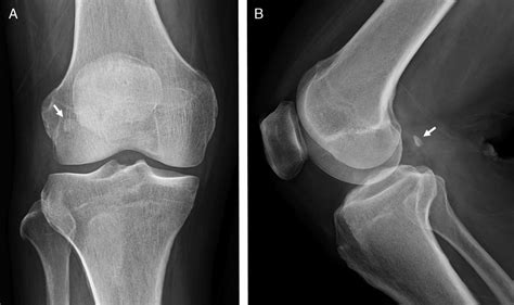 Sonographic Diagnosis and Treatment of Fabella Syndrome: A N ...