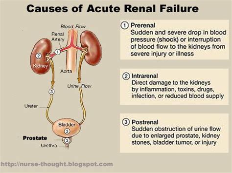 Acute Kidney Failure | Acute renal failure, Chronic renal failure, Renal failure