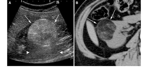 Angiomyolipoma, classic type, in a 61-year-old woman. Ultrasound (A ...