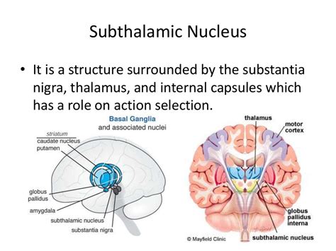 Basal ganglia stroke