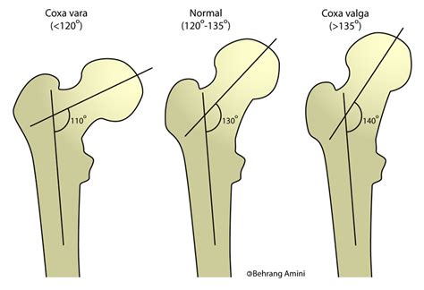 Coxa valga - wikidoc