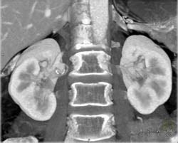 Right Renal Artery Aneurysm - Kidney Case Studies - CTisus CT Scanning