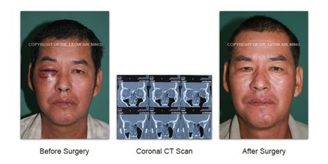 Craniofacial Trauma Reconstruction – MSPRS