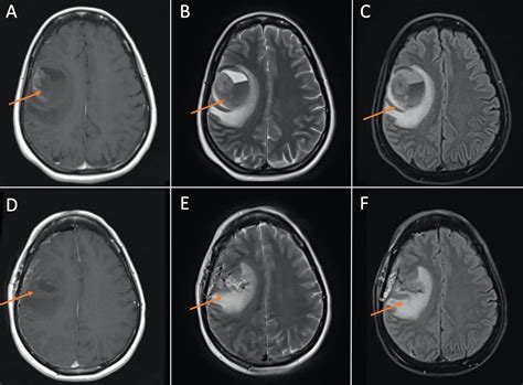 Cureus | New-Onset Neurologic Symptoms and Related Neuro-Oncologic Lesions Discovered After ...