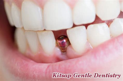 Kitsap Gentle Dentistry: Dental Crown Benefits and Problems