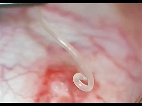 There's a worm in my eye! Loa Loa worm removed from eye in Austin, TX ...