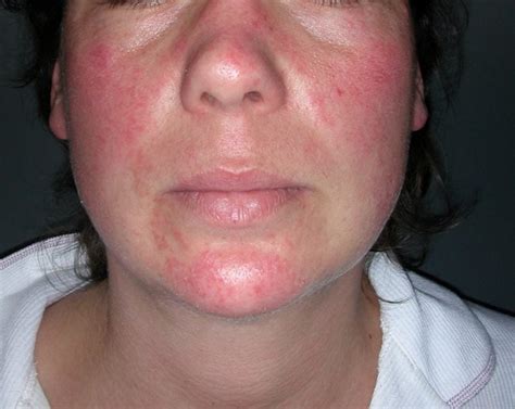 Skin Manifestations of Thyroid Disorders: A Review - Dermatology Advisor