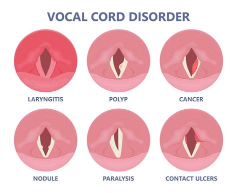 How to actually fix a lost voice, according to science (hint: lemon and ...