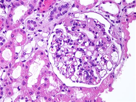 Pathology Outlines - Acute postinfectious glomerulonephritis