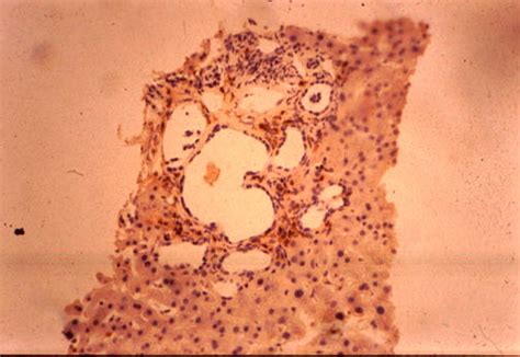 Pathology Outlines - Caroli disease