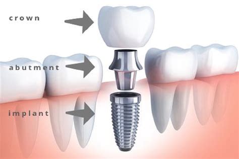 ITI Implant System - PANDA ORAL