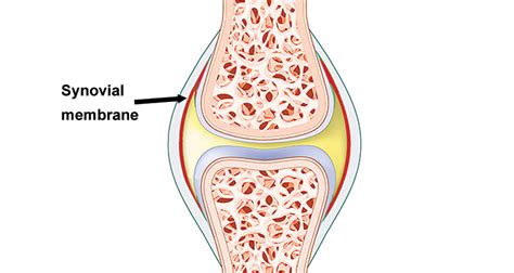 Can Synovitis Be Caused By Trauma - mapasebab