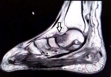 Madura Foot: MRI - Sumer's Radiology Blog