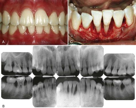 25: Aggressive Periodontitis | Pocket Dentistry