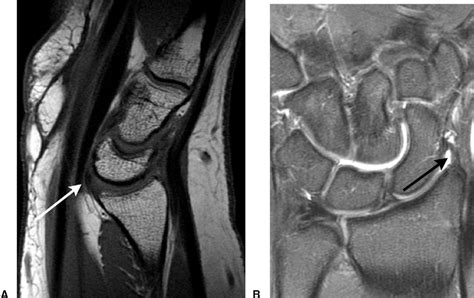 MRI of wrist ligaments. | Semantic Scholar