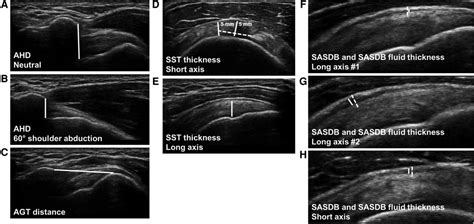 Subdeltoid Bursitis Ultrasound