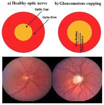 Glaucoma Information Glaucomatous Optic Disc Glaucoma Information | My XXX Hot Girl