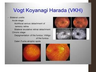 Sympathetic ophthalmitis | PPT