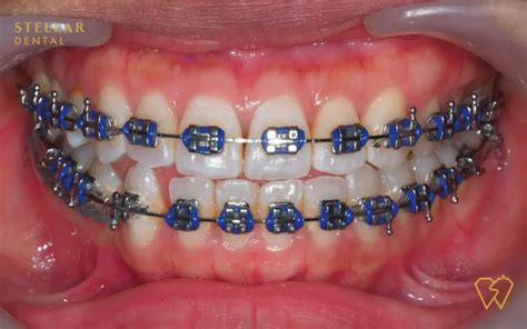 Braces Colors: Top Picks For 2023 - Stellar Dental