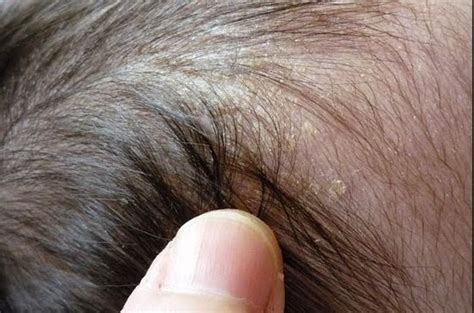 Causes of Non-Contagious Dry Scalp in Infants and Children