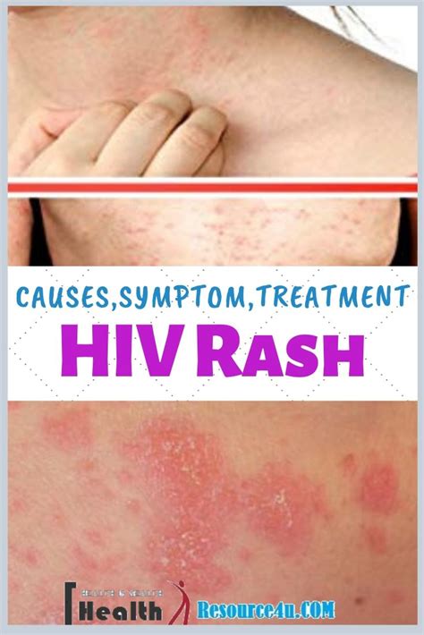 HIV Rash - Causes, Picture, Symptoms, Types, Home Treatment