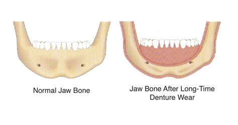 Missing Teeth? What Happens To The Jaw Bone Without Tooth Roots. | Ban ...