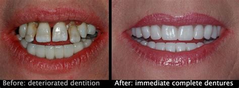 Immediate Dentures - Denture Professionals Rockingham & Pinjarra