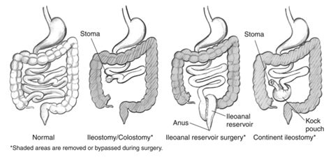 Kock Pouch Stoma