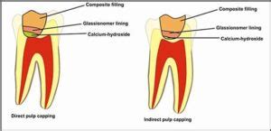 Pulp capping
