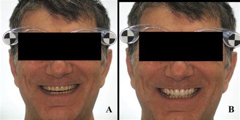 The step further smile virtual planning: milled versus prototyped mock ...