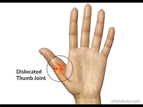 How I Dislocated My Thumb - YouTube