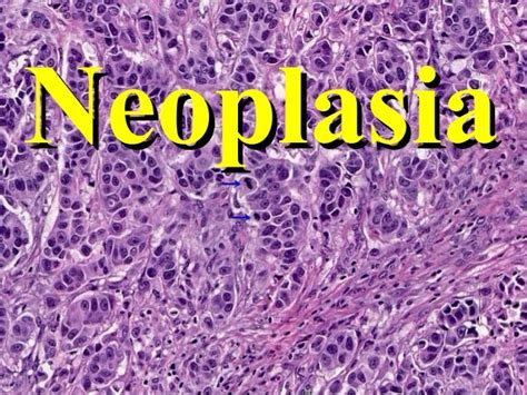 Neoplasm: Neoplasia Neoplasm