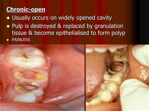 PPT - PULPITIS Inflammation of dental pulp Main source for dental pain ...