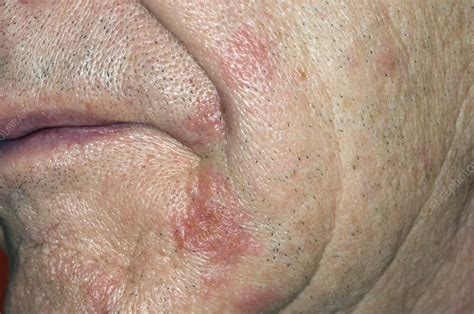 Shingles rash on the face - Stock Image - C008/5780 - Science Photo Library