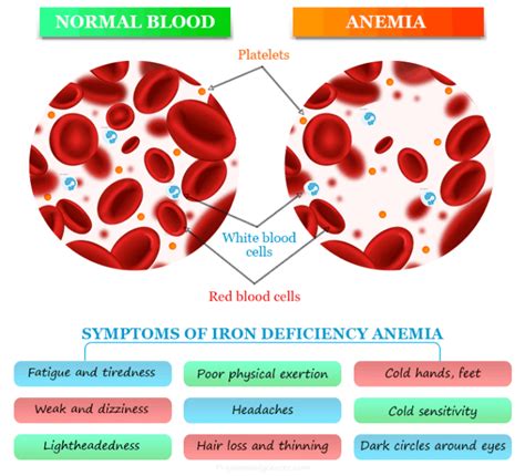 Iron Deficiency Anemia - Causes, Symptoms, Treatment