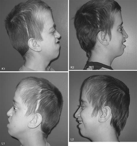 SUBCRANIAL LE FORT III OSTEOTOMY AND MODIFIED LE FORT III OSTEOTOMY ...