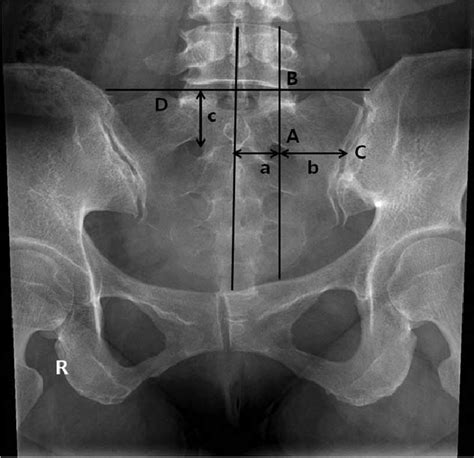 Sacral Foramina Xray