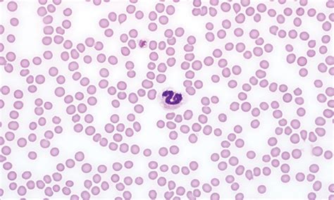 Blood Smear Platelet Evaluation & Interpretation | Clinician's Brief