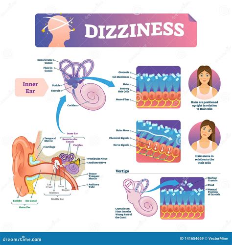 Dizziness Vector Illustration. Labeled Scheme With Inner Ear And Vertigo. | CartoonDealer.com ...