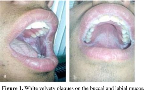 White Sponge Nevus: Report of a Case and Review of the Literature ...